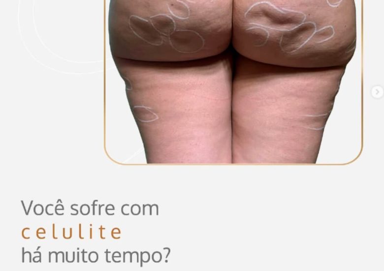 Você sofre com celulite a muito tempo?