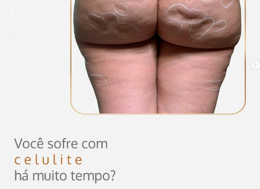 Você sofre com celulite a muito tempo?