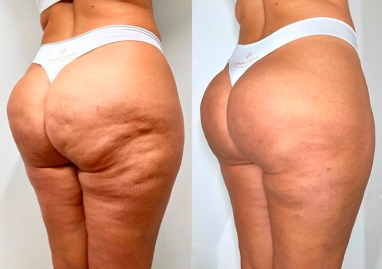 É possível tratar a bananinha sem cirurgia