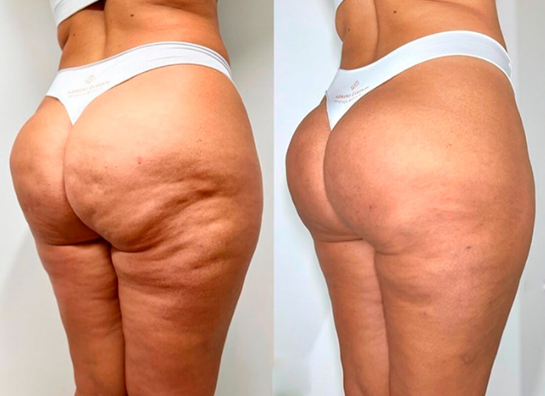 É possível tratar a bananinha sem cirurgia