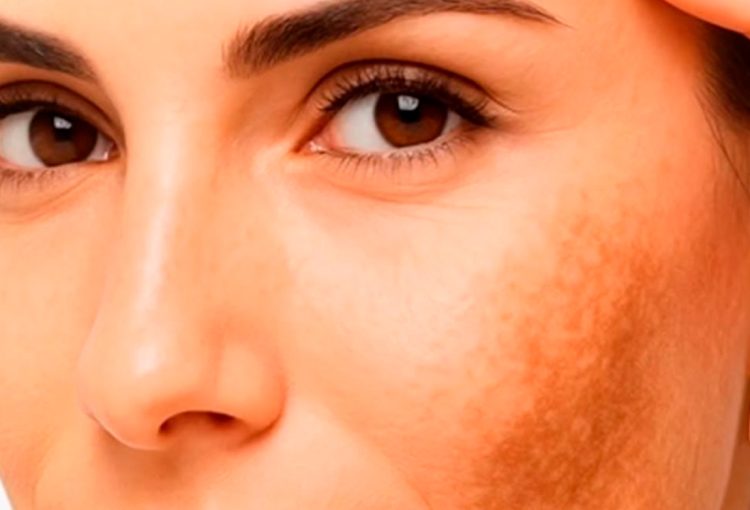 Seu melasma não melhora?