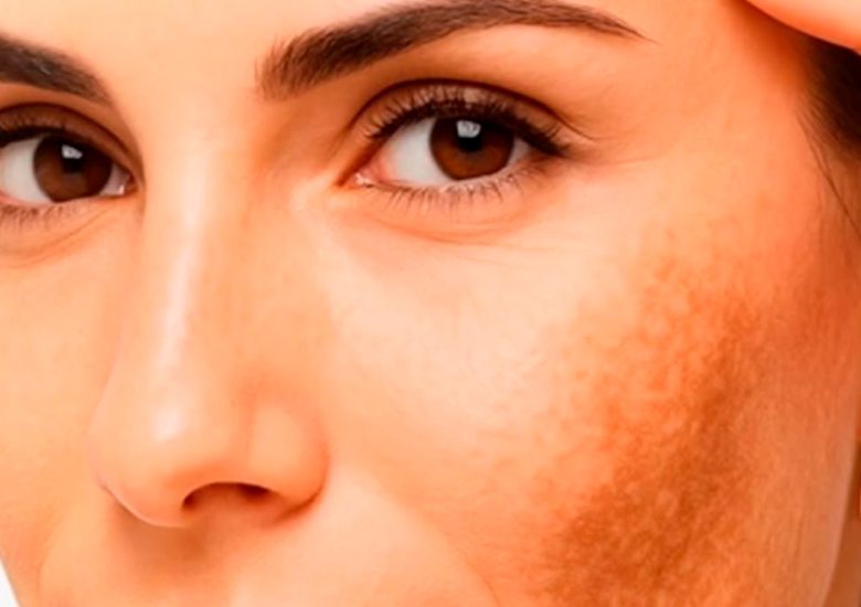 Seu melasma não melhora?