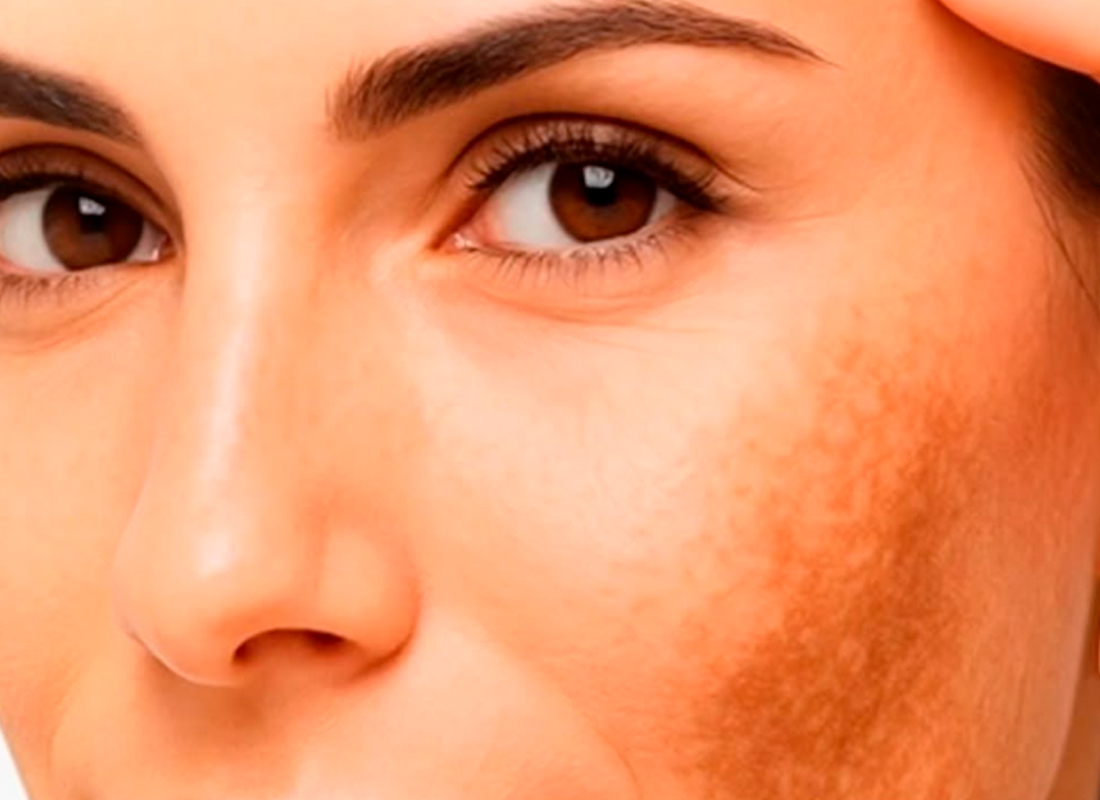 Seu melasma não melhora?